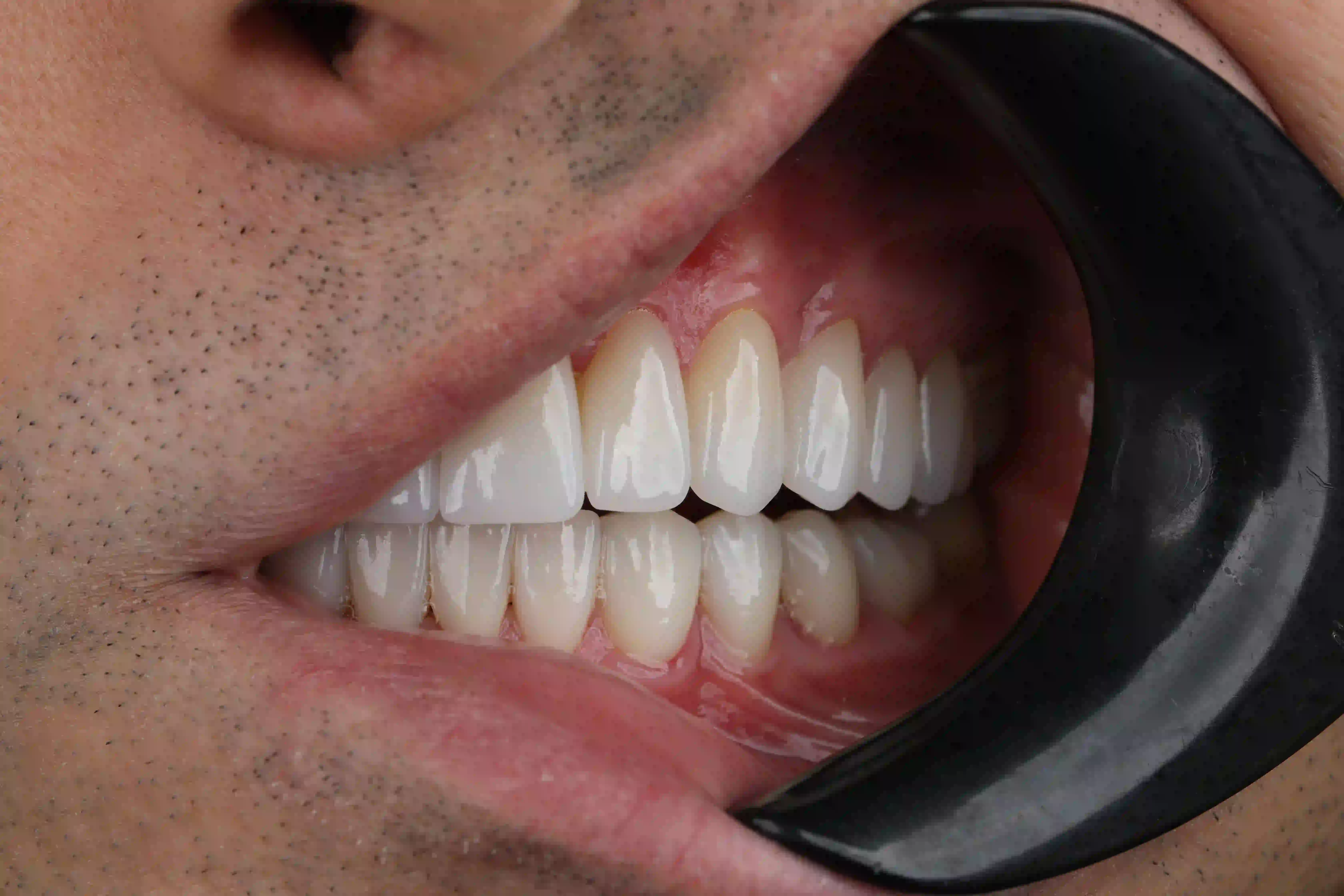 Bergedent clinical team coordinating full-mouth cases