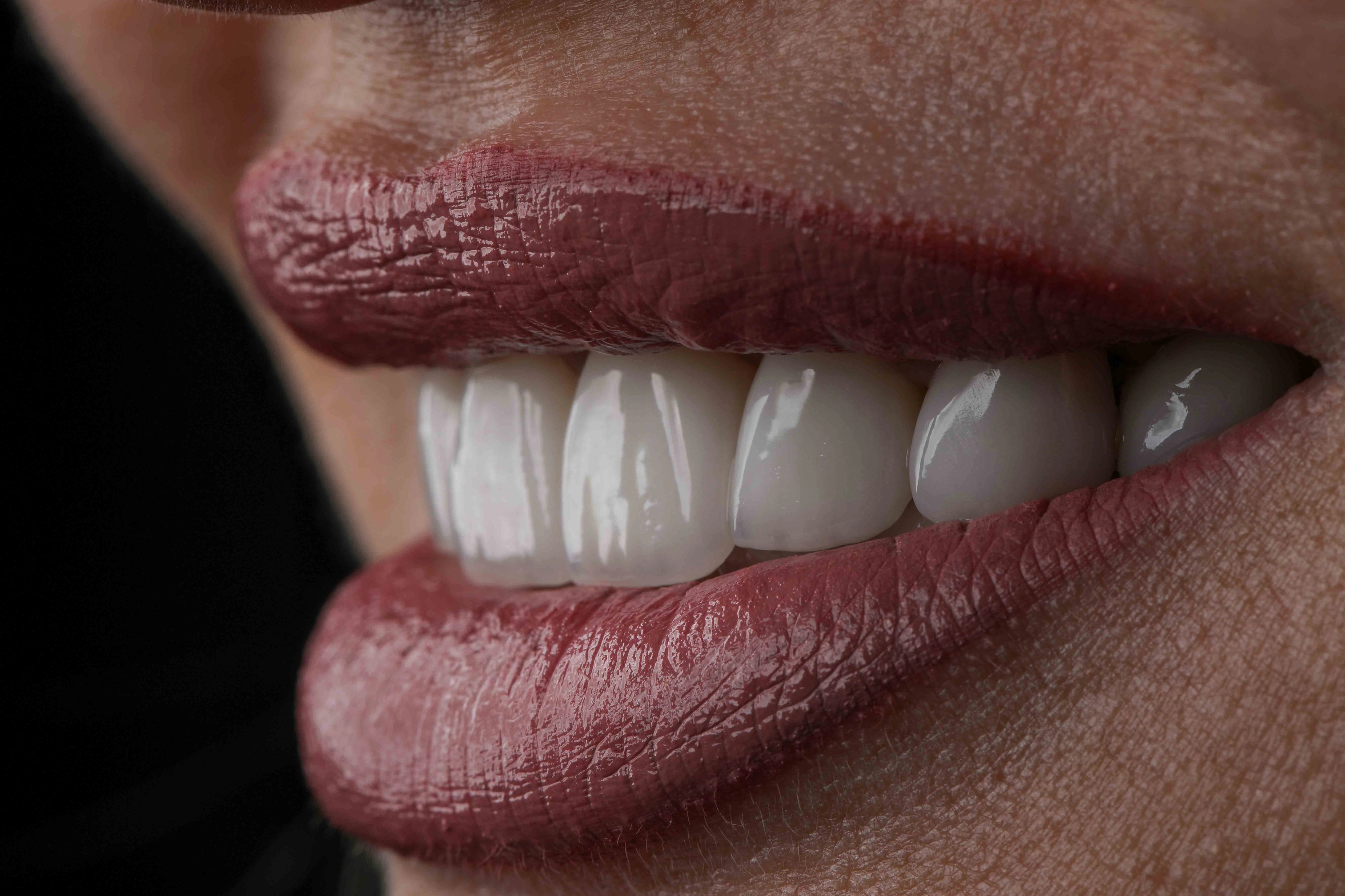 Glossy smile appearance after veneer treatment at Bergedent Istanbul