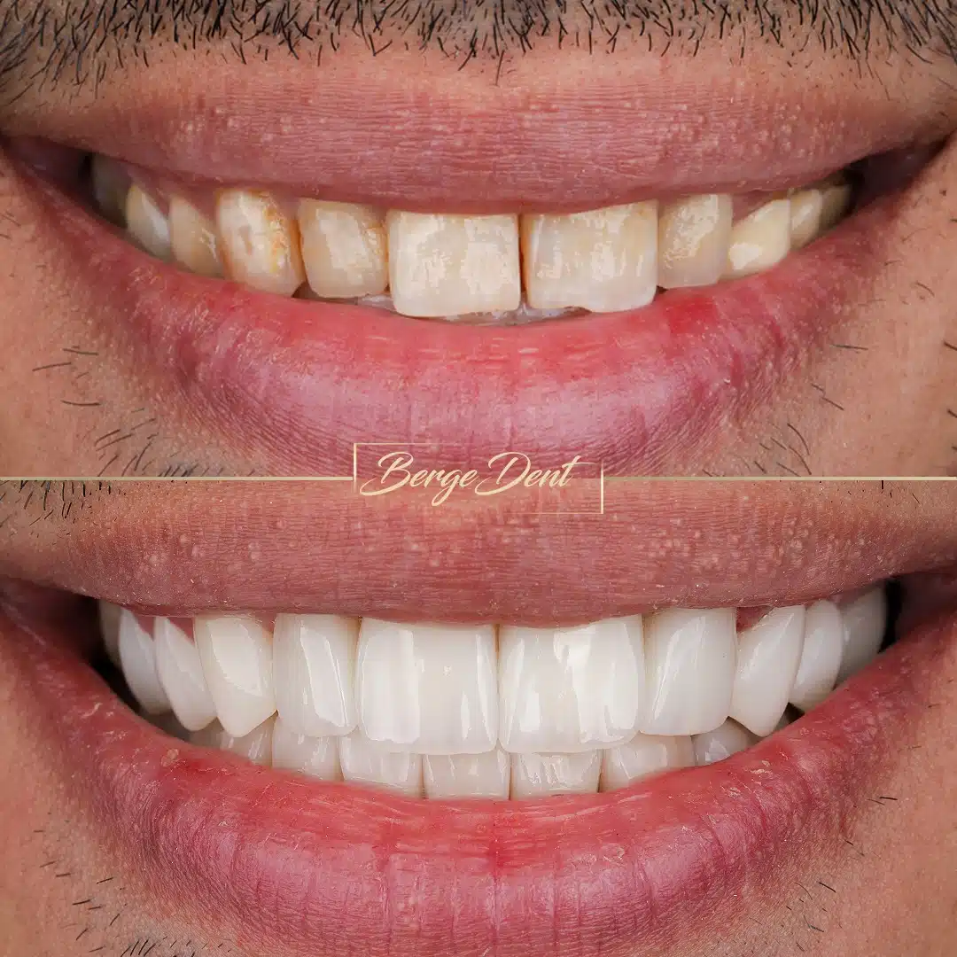 Bright smile appearance after whitening at Bergedent Istanbul